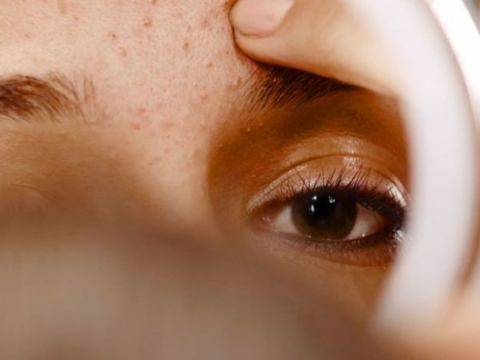 7 coisas que a acne pode dizer sobre sua saúde